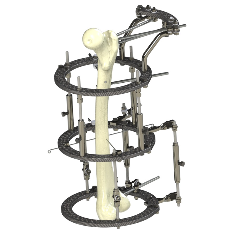 Sistema de fixação externo ILIZAROV
