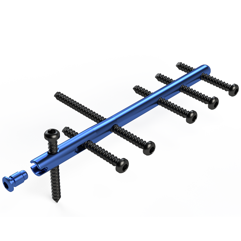 Haste Intramedular Bloqueada em Titânio